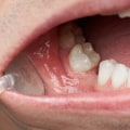Exploring the Causes of Tooth Loss