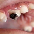 Treatment Options for Cavities: What You Need to Know