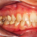 Understanding the Symptoms and Warning Signs of Gum Disease