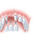 Understanding Your Options for Replacing Missing Teeth