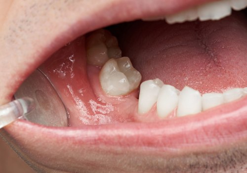 Exploring the Causes of Tooth Loss