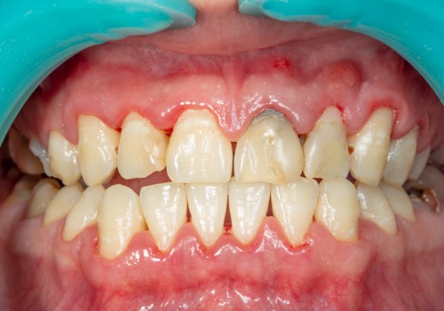 Understanding Gum Disease: Types and Stages for Better Oral Health