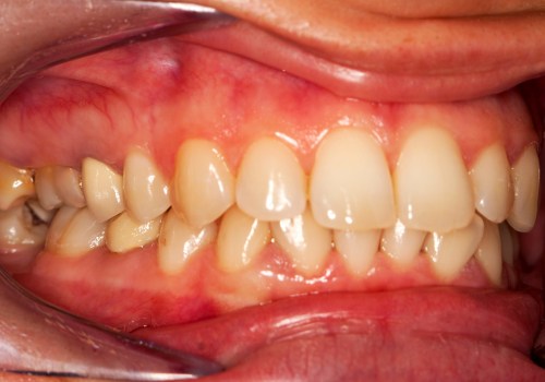 Understanding the Symptoms and Warning Signs of Gum Disease