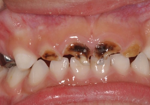 Understanding the Causes and Prevention of Tooth Decay and Cavities