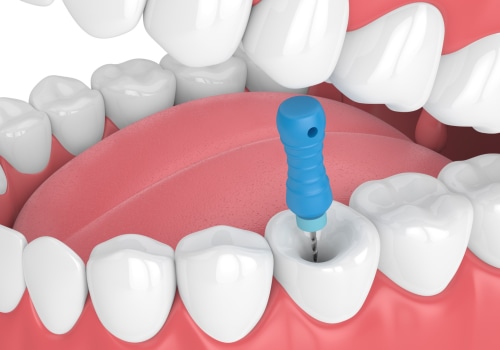 Understanding Endodontics