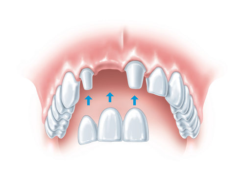 Understanding Your Options for Replacing Missing Teeth